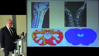 2019 Think Tank: Cervical Medullary Syndrome & Cranial Instability - Fraser Henderson, MD