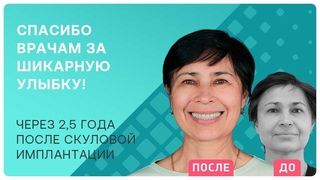 Скуловая имплантация Zygoma: шикарная улыбка за 3 дня!